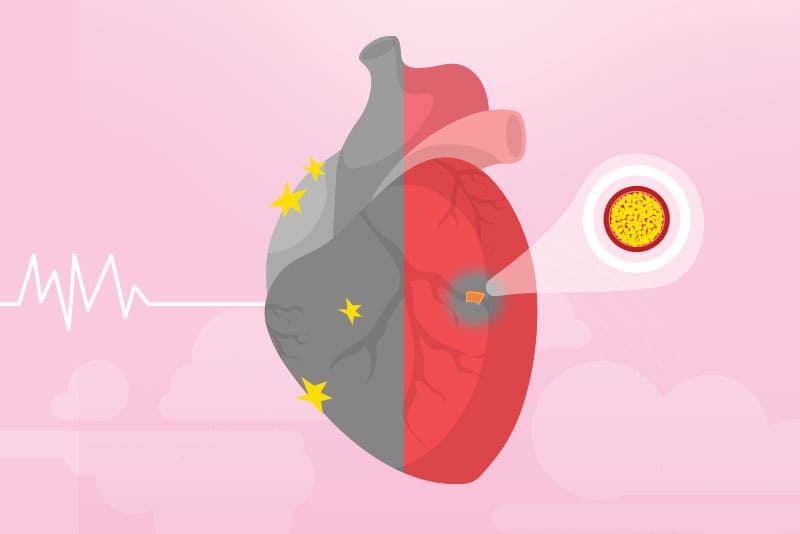 Infarto x Parada cardíaca: Diferenças e formas de prevenção