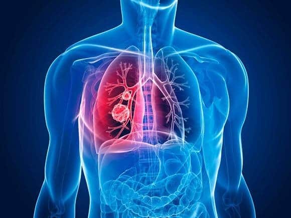 No Dia Mundial da DPOC, entenda como prevenir, diagnosticar e tratar doenças pulmonares com apoio da tecnologia médica da CMOS Drake.